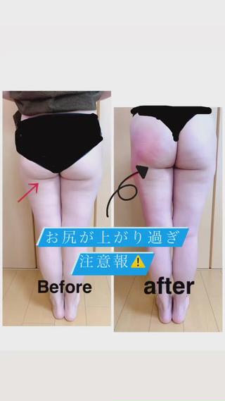 痩身キャビテーション【モニター】
︎︎︎︎︎︎︎左だけ施術
左お尻のリフトアップ具合が
凄い
お尻の線が全然違う
キャビテーションで
脂肪をガッツリ溶かして
バキュームでセルライトを潰して
流します
正しい位置に戻します
そして身体をじっくり温める事で
血液の流れも良くなり
基礎体温が1度あがるだけで200キロカロリーの
消費にもなります
運動で換算すると1時間ウォーキングするのと
同じカロリー
楽して痩せましょう