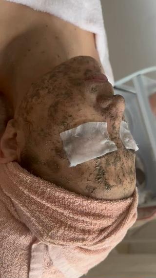 剥離なし
ハーブトリートメント
ハーブピーリング 