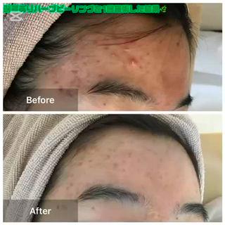 おでこのニキビが気になって前髪があげれない
どうしても隠してしまうというお客様でしたが
少しづつニキビも落ち着き自身が持てたとおっしゃっておりました