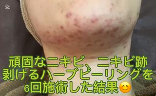 ハーブピーリング専門 MOKAのエステ・リラクイメージ