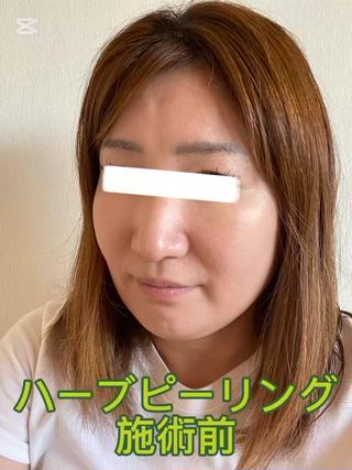 ハーブピーリングの流れを動画にしております☆ご不明点あればお気軽にご連絡下さい