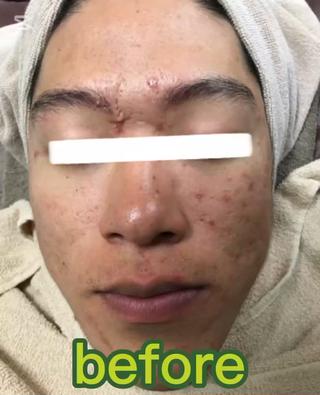 男性のお客様も多数ご来店されてます。
今まで美容に興味なくて、何したら良いかわからない。
ハーブピーリングとは何か、わからないってお客様も多数いらっしゃいますので、お気軽にご相談ください