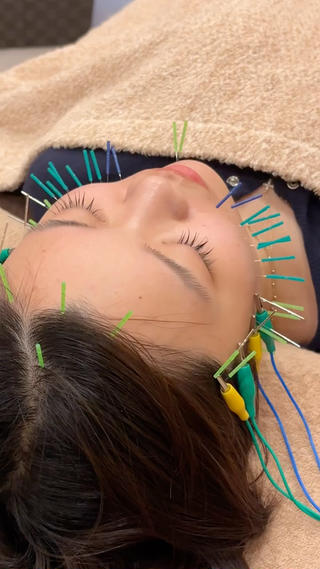 【学割U24】※16未満の施術はお断りしています

10代〜幅広い年代の方にご利用いただいております！

●むくみ
●肌荒れ(ニキビ・ニキビ跡)
●エラ張り

美容医療は手が出せないけど、美容鍼なら…！と
ご来店いただく方が多いです

カウンセリングから丁寧に施術させていただきますので、
ぜひ一度ご相談ください 