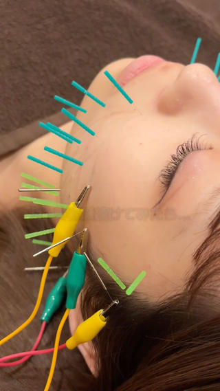 お顔の左右差＆小顔になりたい！

月イチ美容鍼を継続してくださっているお客様

3回目でだいぶ左右差整ってきました！
まだ戻りやすいため、このまま継続していきます！ 