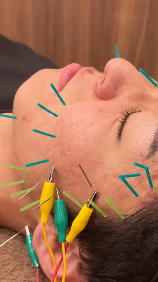 不眠による肌荒れも美容鍼で

治ったと思ったら次々と新しいニキビが…
そんな方は美容鍼とララピールで内側から
変えていきましょう！！ 