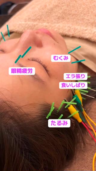 エラ張り、小顔、リフトアップ、たるみ、しわ…

美容鍼なら一度に対応できるお悩みがたくさん
お悩みが多い方におすすめ！

毛穴ケアや美白、艶肌はララピールとのセットメニューがオススメです 