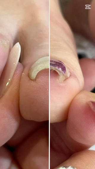 巻き爪解放2回目︎