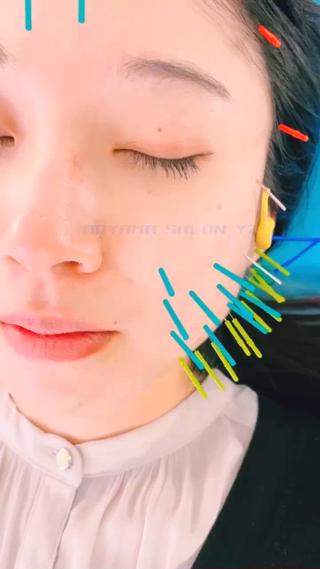 『別人級』の変化を目指すなら
#電気を流す美容鍼 