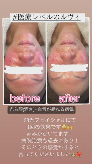 SR光フェイシャルの効果大！
強さレベルも調整できますよ♪ 