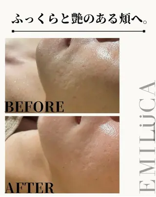 ニキビ・ニキビ跡🌿 ハーブピーリング✨のその他イメージ