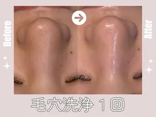 毛穴・ニキビケア ￤肌質改善￤EMIのエステ・リラクイメージ