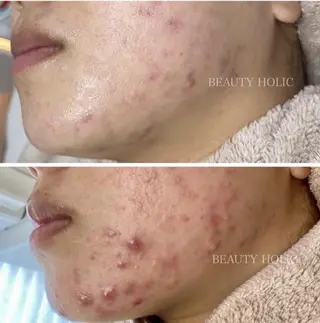 ニキビ・ 肌荒れ専門店のエステ・リラクイメージ