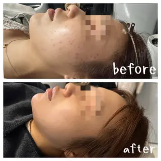 小顔・毛穴/ニキビ/ ハーブピーリング専門のエステ・リラクイメージ