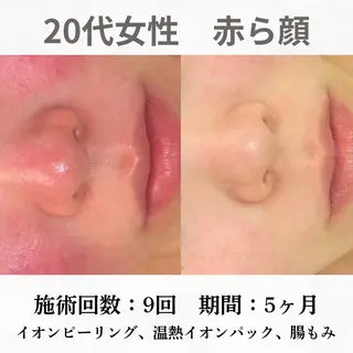 重度ニキビ専門🌷 ダウンタイムなしのエステ・リラクイメージ