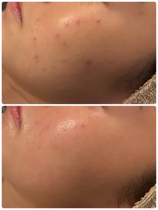 【リベルハーブピーリング認定店】敏感肌・美白脱毛専門店Dione立川店所属・Dione 立川店のエステ・リラクイメージ