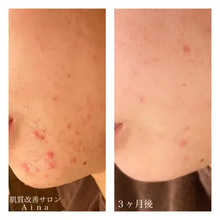 セミロング カラー パーマ ヘアアレンジ メンズ キッズ ネイル マツエク・マツパ ニキビ跡専門サロン Ainaのエステ・リラクイメージ
