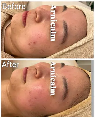 ハーブピーリング 肌再生ピーリング/のエステ・リラクイメージ