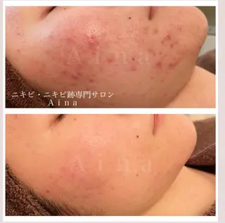 ショート カラー パーマ ヘアアレンジ メンズ キッズ ネイル マツエク・マツパ アイブロウ ニキビ跡専門サロン Ainaのエステ・リラクイメージ