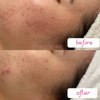 小顔/毛穴/ニキビ salon bealのエステ・リラクイメージ