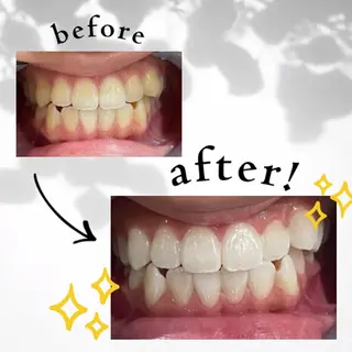 セルフホワイトニング 都立大学🦷✴︎のその他イメージ