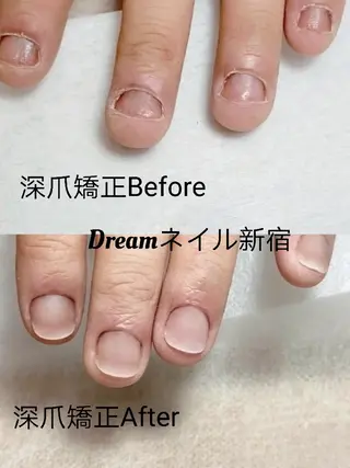 ネイル フィルイン・深爪矯正 長さ出し🎀のネイルデザイン