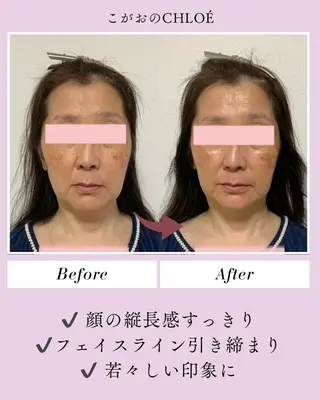 小顔サロン こがおのCHLOÉのエステ・リラクイメージ
