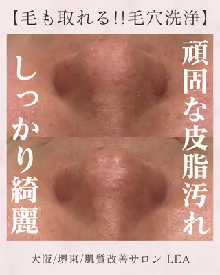 Lea堺東　毛穴洗浄 ×顔ワックス脱毛のその他イメージ