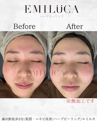 ハーブピーリング専門EMILUCA藤沢所属・ハーブピーリング /KAEDEのエステ・リラクイメージ