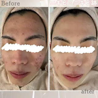 ニキビ&跡改善サロン オーナー光木のエステ・リラクイメージ