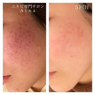 セミロング パーマ ヘアアレンジ メンズ キッズ ネイル マツエク・マツパ アイブロウ ニキビ跡専門サロン Ainaのエステ・リラクイメージ
