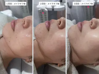 |ピーリング・毛穴| soina神楽坂のエステ・リラクイメージ