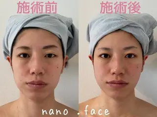 マツエク・マツパ nano.face名古屋駅前店所属・美容鍼/小顔&整体 nano.faceのエステ・リラクイメージ
