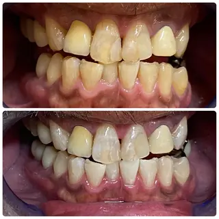 セルフホワイトニング 🦷口元垢抜け✨のその他イメージ