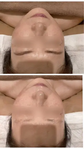 頭蓋骨小顔矯正 ハーブピーリングのエステ・リラクイメージ