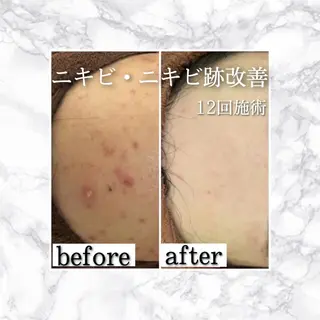 3か月で肌革命👼 ニキビ専門店💫のエステ・リラクイメージ