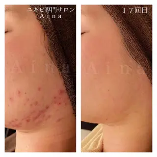セミロング パーマ ヘアアレンジ メンズ キッズ ネイル マツエク・マツパ アイブロウ ニキビ跡専門サロン Ainaのエステ・リラクイメージ