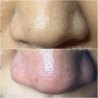 ネイル＆毛穴洗浄 ヤマネイル 山根のネイルデザイン