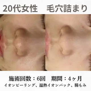 重度ニキビ専門🌷 ダウンタイムなしのエステ・リラクイメージ