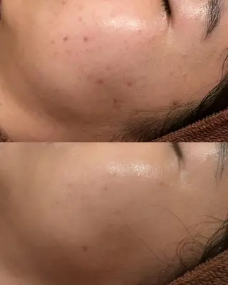 3か月で肌革命👼 ニキビ専門店💫のエステ・リラクイメージ