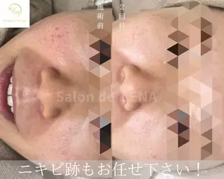 ハーブピーリング専門 サロンドレナ平岡のエステ・リラクイメージ