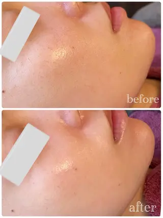 ハーブピーリング 痩身　漢方よもぎ蒸しのエステ・リラクイメージ