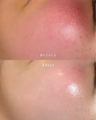 肌質改善| Rootree Miのエステ・リラクイメージ