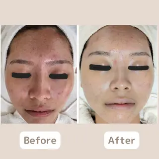 〈ニキビケアサロン〉 レゾン京橋店/ 浅川のエステ・リラクイメージ