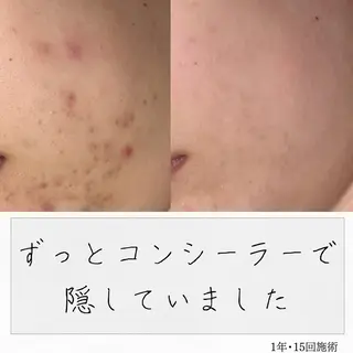 ニキビ経験者が施術 する専門サロン🌻のエステ・リラクイメージ