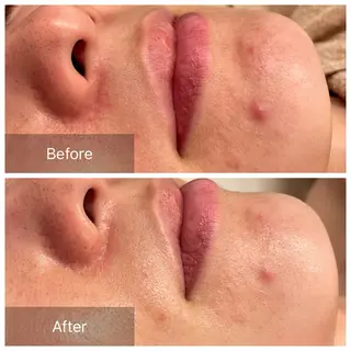 ハーブピーリング 肌再生ピーリング/のエステ・リラクイメージ