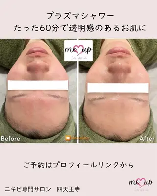 Meupニキビ専門店 背中/ハーブ/肌管理のその他イメージ