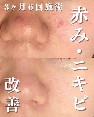 3か月で肌革命👼 ニキビ専門店💫のエステ・リラクイメージ
