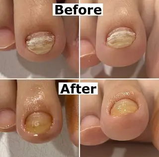 ネイル Mellow nail所属・巻爪無料モデル募集 ✨🦶MEGUMIのネイルデザイン