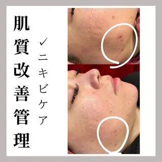 WAX・肌質改善・毛 穴洗浄/林愛真のエステ・リラクイメージ
