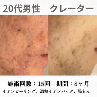 重度ニキビ専門🌷 ダウンタイムなしのエステ・リラクイメージ